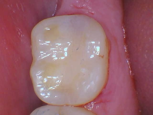 Tooth Colored restoration After