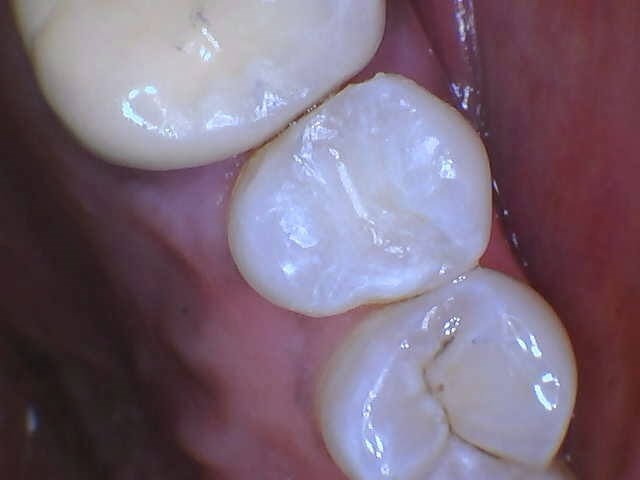 Tooth Colored restoration After