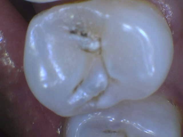 Tooth Colored restoration Before